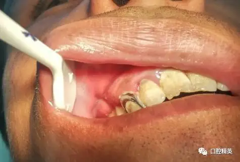 根尖周炎伴发脓肿1例