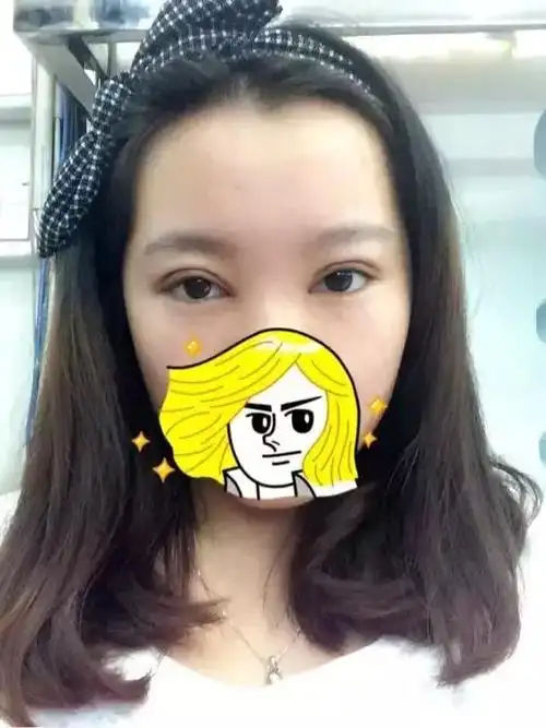 双眼皮恢复期1到3个月效果图,全切双眼皮一个月和三个月恢复图(双眼皮