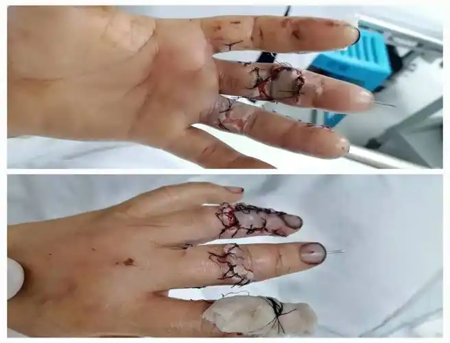 断指"复活"了——我院脊柱关节外科再次成功开展断指再植术_手术_伤者