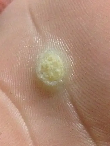 脚底上几个月前就长了这两个东西,一直退不掉,走路非常疼,去医院看了