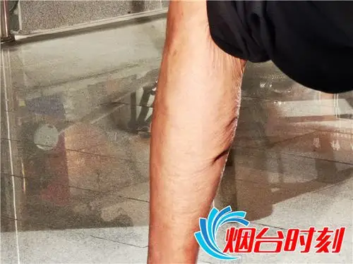 李作响左腿被子弹打穿处留下永久的伤疤