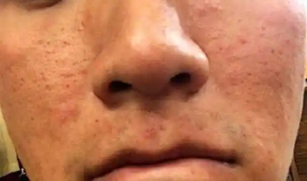 立秋过后,脸上螨虫成群结队,教你一个小妙招,把螨虫一窝端