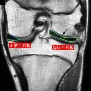 父母必知孩子膝关节突然伸不直了是怎么回事一文带你了解盘状半月板