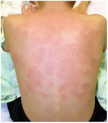 病案一例6岁男孩的大疱性系统性红斑狼疮