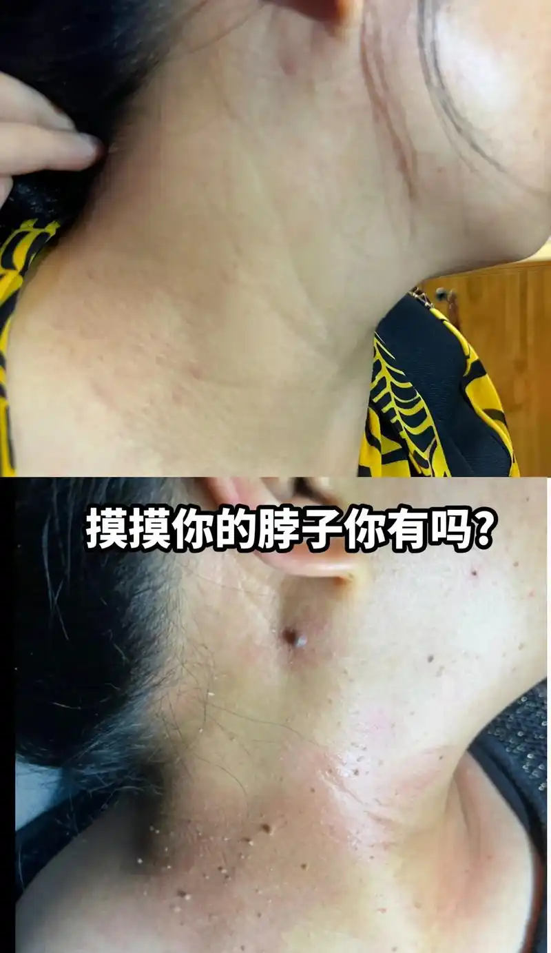 摸摸你的脖子你有吗?#问题性皮肤管理 #扁平疣 #丝状疣 # - 抖音