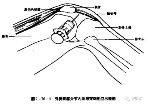 常用关节腔穿刺方法技巧大全都在这里了