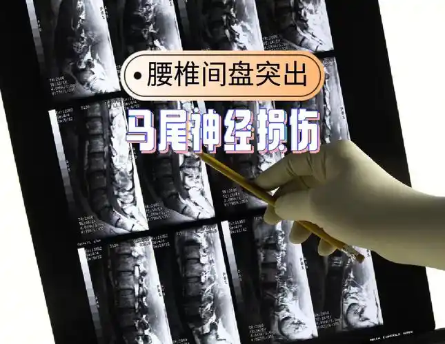 北京太壹园中医8215通过手术缓解外界因素对马尾神经的压迫或