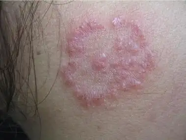 体癣由真菌感染.