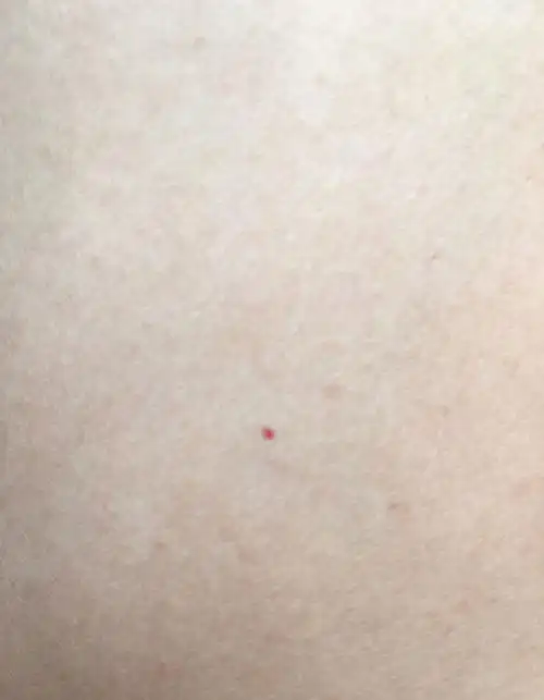 身上胳膊上有很多小血点,不疼不痒,这是什么情况