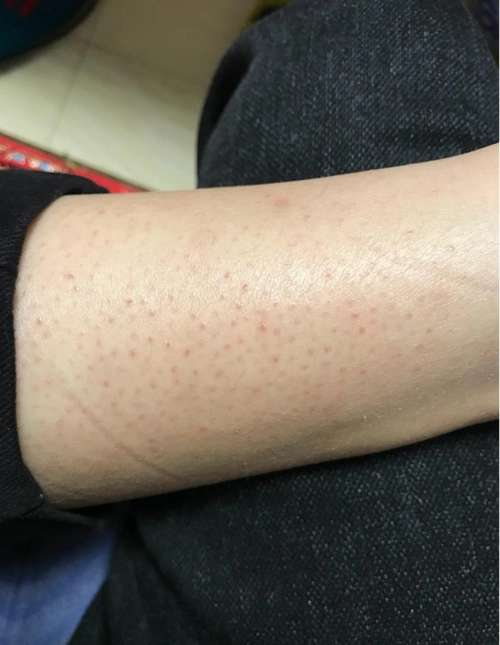 "鸡皮肤"怎么治疗?_毛周角化病_症状表现_治疗方式 - 好大夫在线