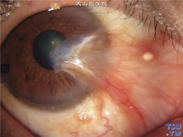 翼状胬肉症状及手术治疗效果图解