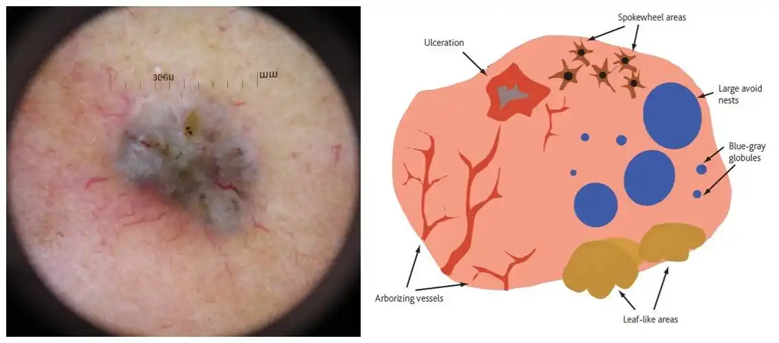 简述一例基底细胞癌的诊治过程