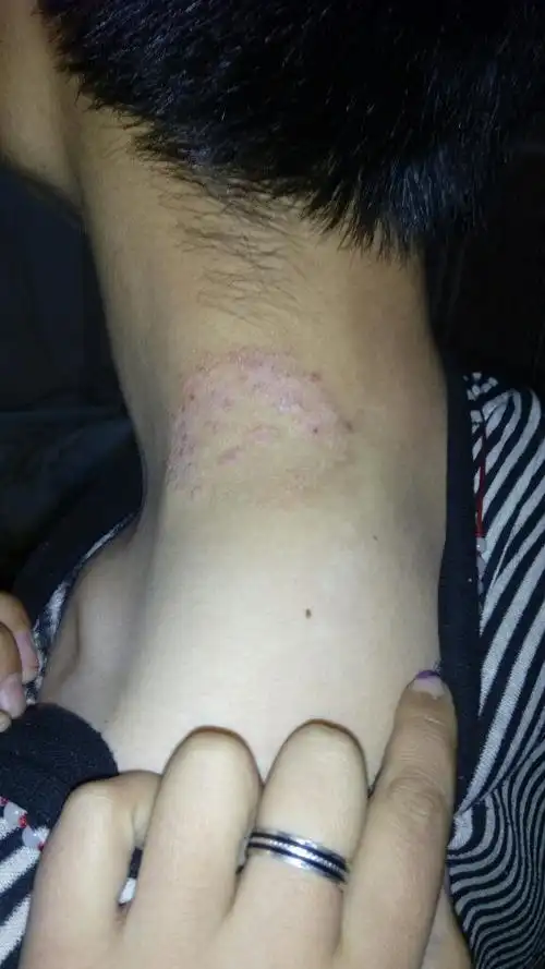 谁知道这是怎么回事,在脖子上,总痒