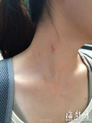 李女士脖子有明显抓痕(@东方早报发布的网友微博图)