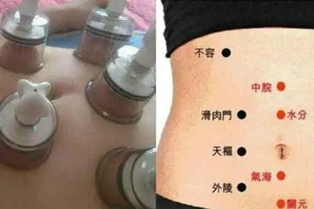 拔罐减肚子拔哪里图解 教大家几招快速瘦身 - 局部减肥 - 辣妈营