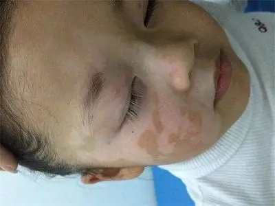 白癜风患者需要了解的常识,你了解了吗