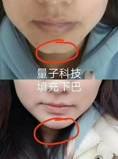 99 没有下巴,谈何精致[调皮] 下巴有坑的人,十有八九都漏财, 有坑就