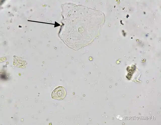 看图识细胞之"卫生部2017年尿液沉渣形态学质控"