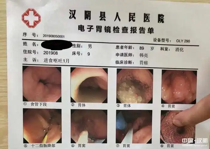 汉阴县人民医院成功开展胃镜下行胃内支架植入术