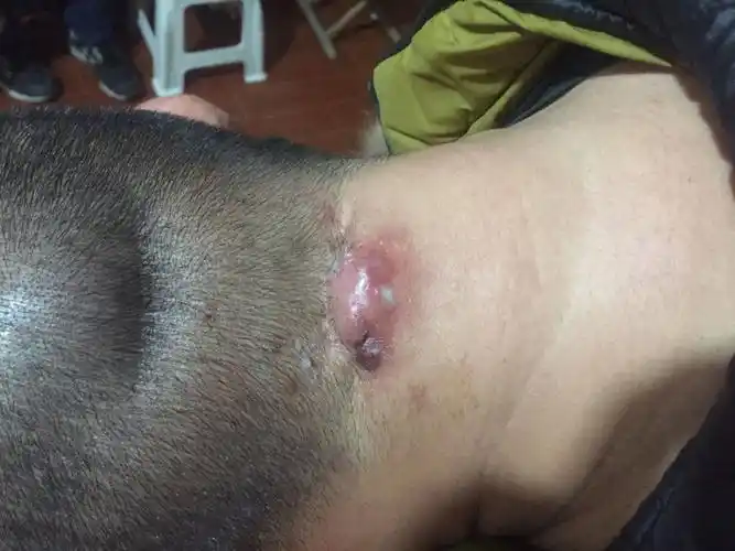 请问哪位神人可以救救我,脖子后面一只长了一个包,两年了到现在没好