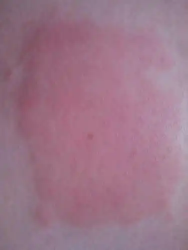 问:贴完药膏后皮肤突然红肿 还特别痒 不知道该抹什么药