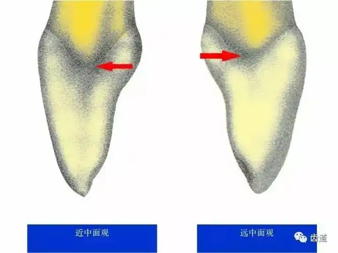 一颗牙的解剖91上颌中切牙解剖形态特征