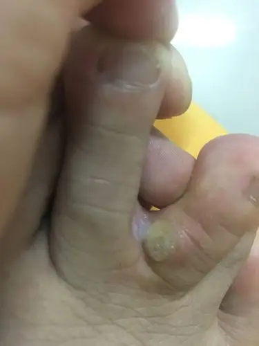 脚上长了一个这样的东西,不知道是什么,怎样去除,原先是一个水泡,后来