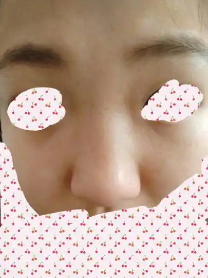 鼻子上方,两眼中间有许多黑点点,其他的地方没有,怎么回事.