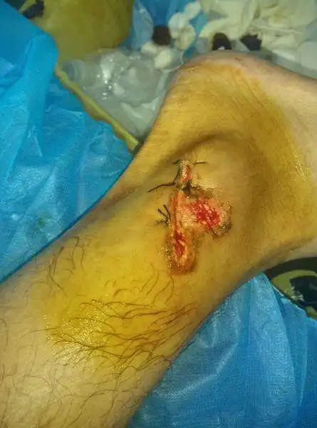 骑电动车摔伤,5cm不规则伤口,有图,缝了三针,包扎好,已经有10日了!