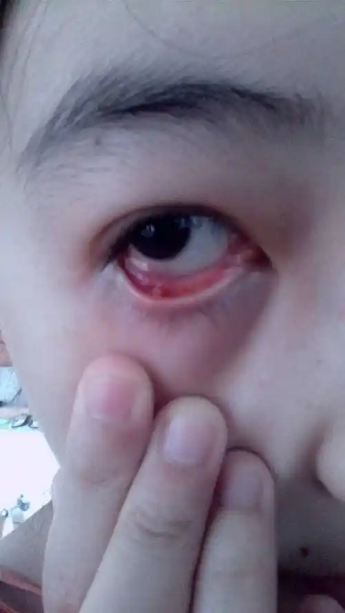 我有更好的答案 2条回答 结膜充血水肿,白色的是结石.