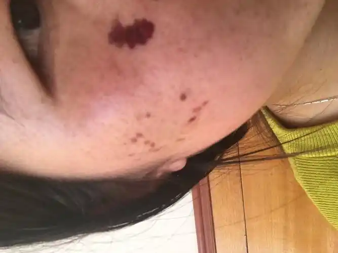 我是刚做完激光祛斑第五天已经结痂但是是薄薄的一层跟皮肤似的