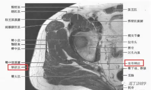 3,梨状肌周围断层解剖2,梨状肌周围结构坐骨神经是人体最粗大的神经