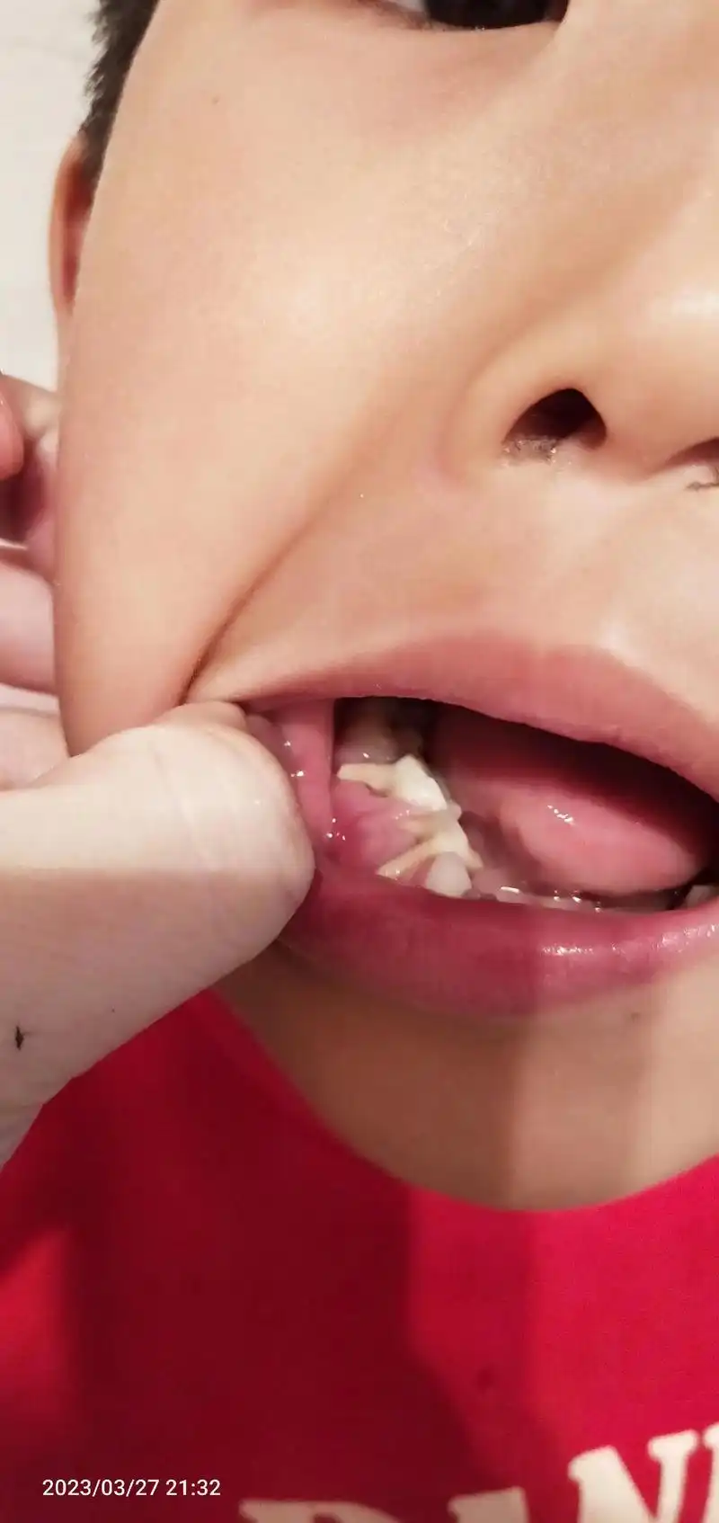 孩子的两颗大牙都莫名其妙的往舌内倾倒,牙根都暴露出来了,去牙 - 抖