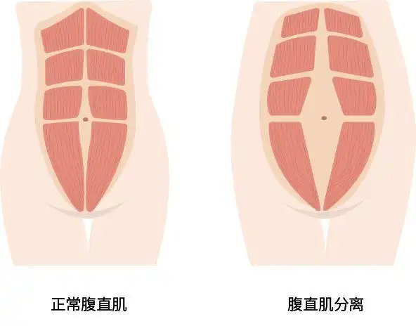 上宽下窄的条索状肌肉,正常状态下左右两侧腹直肌内侧以腹白线相隔