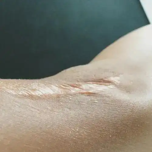 疤痕修复需要多久凹陷疤痕如何修复