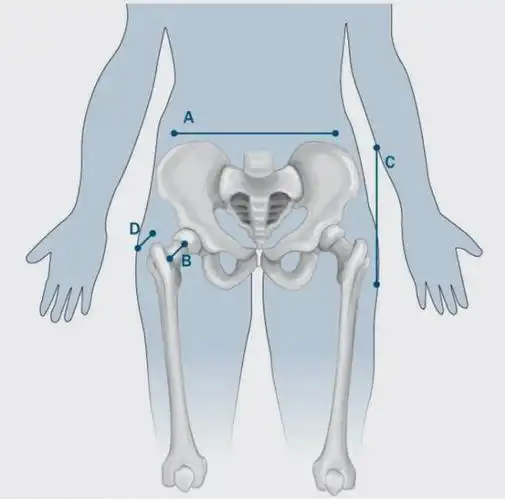 a:髂骨的大小和宽度b:股骨颈的长度和角度c:髂骨和大转子之间的垂直