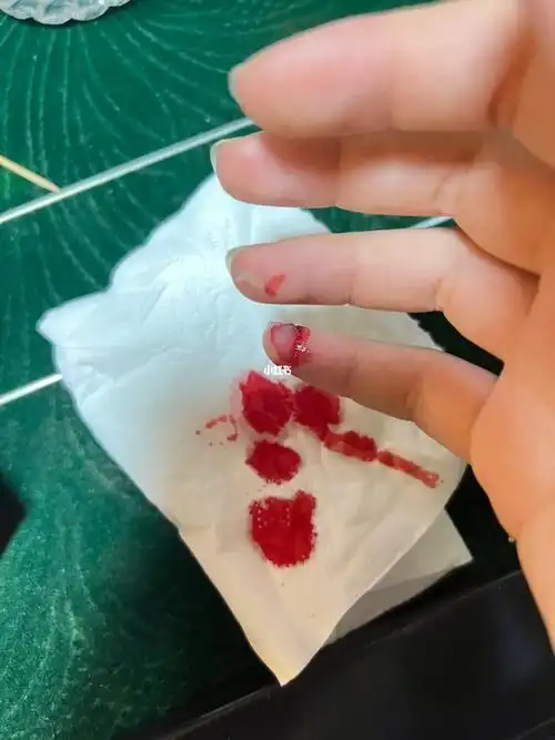 在酒店隔离,也没办法就医,在酒店里摔了一跤,手指头感觉削掉了一小块