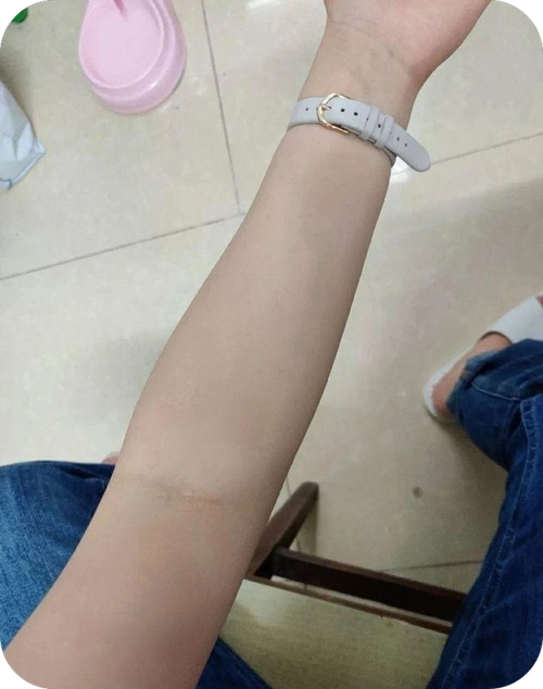 手臂湿疹很痒怎么办?这些方法值得一试