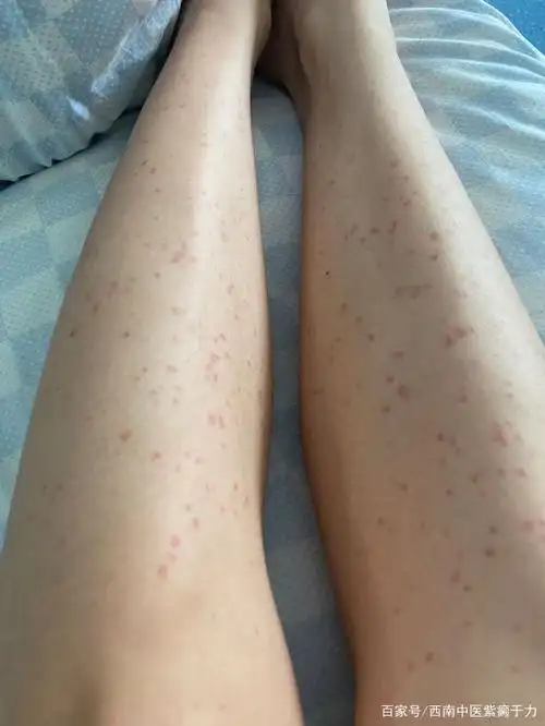 微博粉丝:医生您好,看微博了解到您在治疗紫癜这个领域已有多年,我长