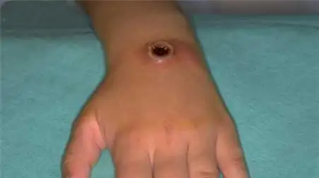 皮肤炭疽,山西皮肤炭疽会全面爆发吗知乎图4