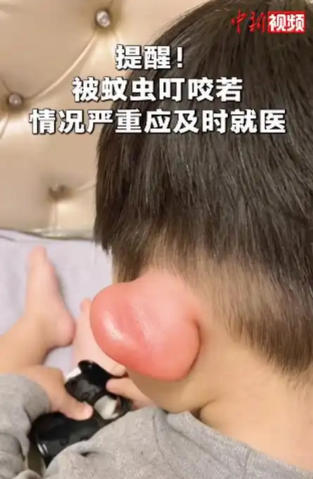男孩被蚊子叮成大耳朵图图好笑又让人心疼的一幕