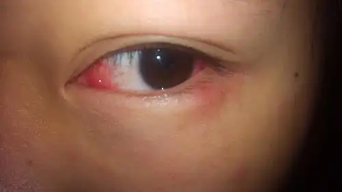 孩子眼睛有红血丝是怎么回事?