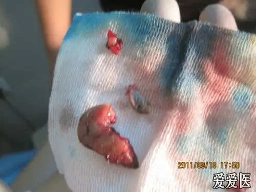 第一例肛周脓肿手术步骤及说明补充术后图片共31张