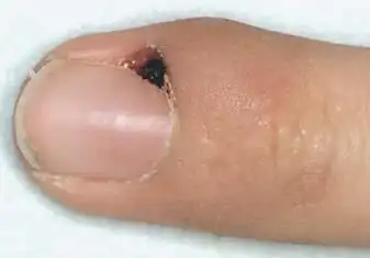 病案甲周的化脓性肉芽肿