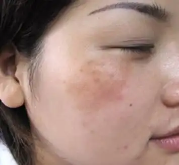 黄褐斑与雀斑的区别是什么