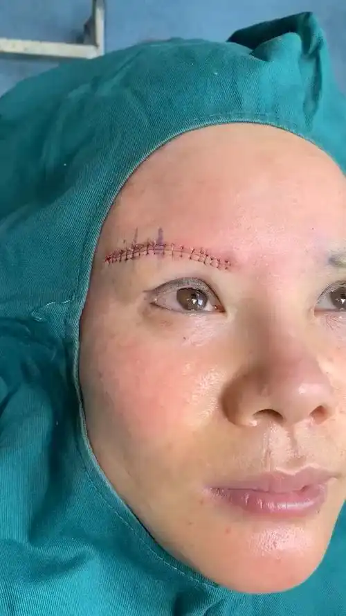 无痕提眉术  ,也称小拉皮,去除眼部松弛的皮肤,改善眼角下垂  ,鱼尾纹