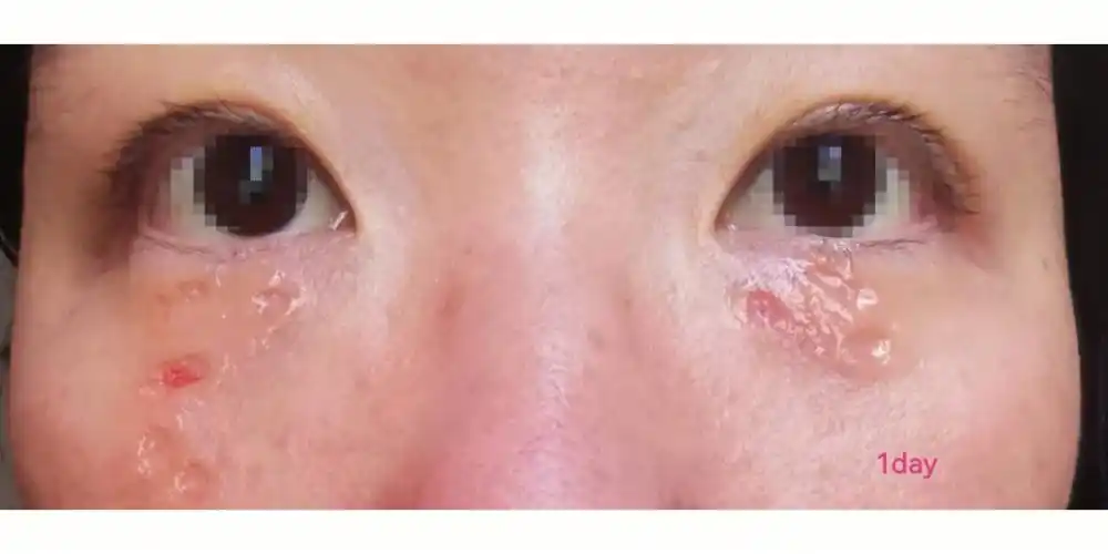 汗管瘤激光效果真实分享