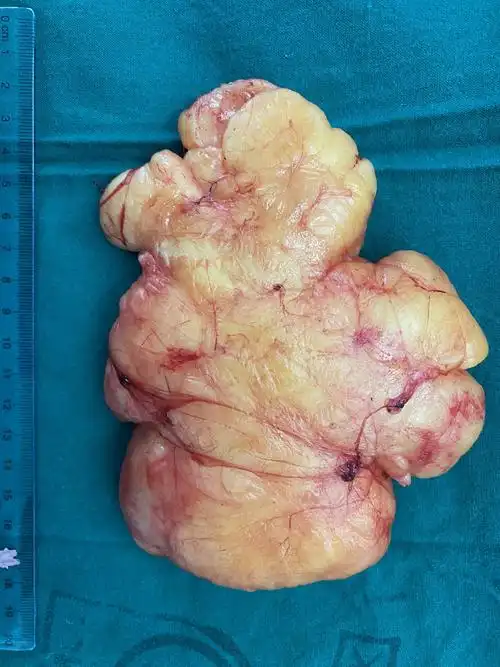 巨大肿物,依然有机会微创解决! - 好大夫在线