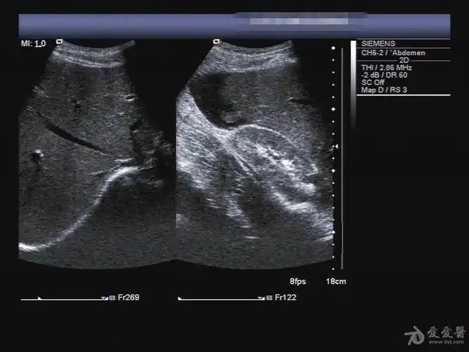 半夜来的脾破裂 - 超声医学讨论版 - 爱爱医医学论坛