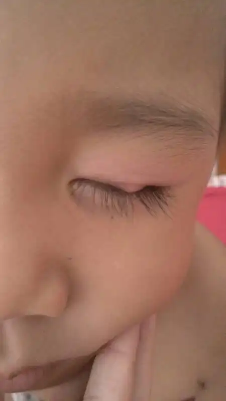 问:宝宝眼睛肿了个包,五天了,起初只是肿一些,以为是虫子咬的,今天肿